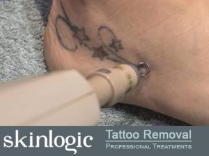 Professional Tattoo Removal Treatments in George